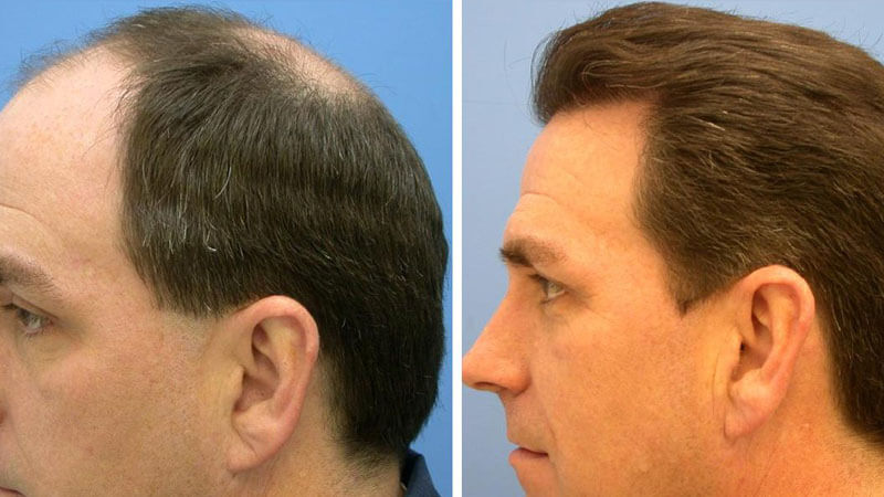 أفضل أطباء زراعة الشعر في أسطنبول أمهر خبراء التجميل في 8 مستشفيات عرب تركبا