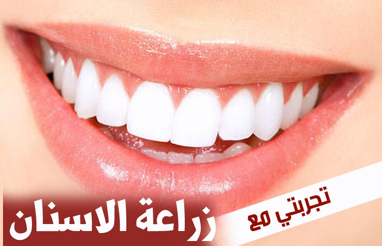 أفضل مستشفى زراعة الأسنان في تركيا تعرف على الأفضل الآن عرب تركيا