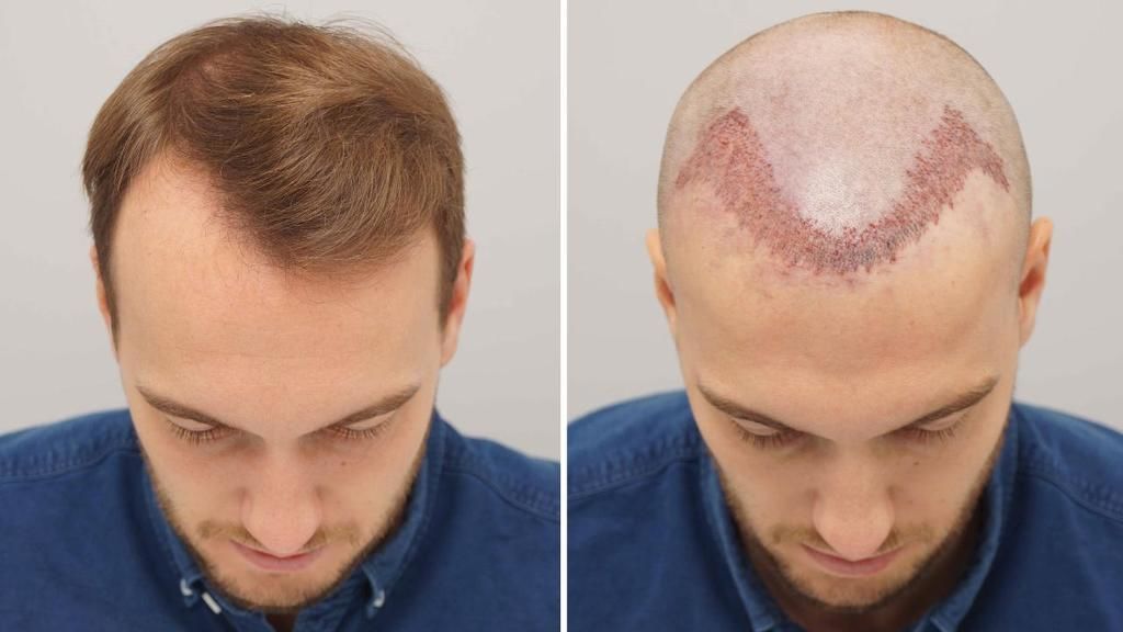 اسعار زراعة الشعر في تركيا اسطنبول تكاليف مميزة من 3 مستشفيات