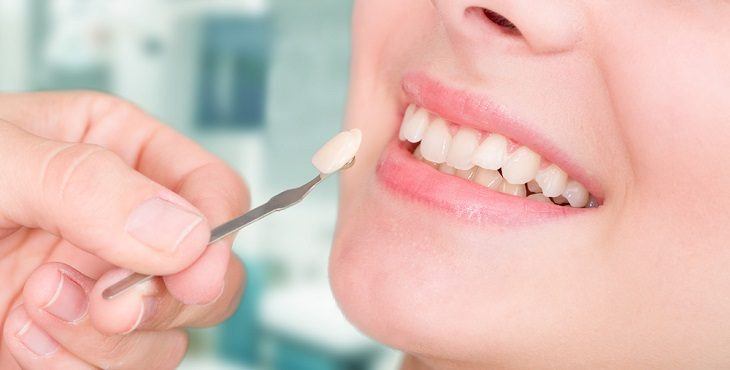 تبييض الأسنان بالليزر 13 تبييض الأسنان بالليزر 13