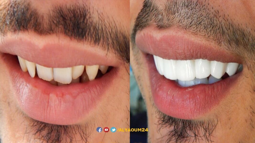 تجارب ابتسامة هوليود
