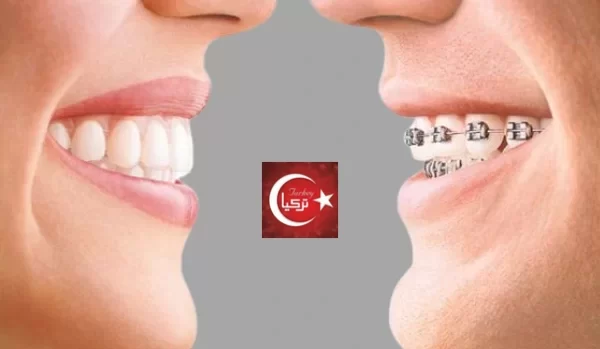 كم مدة زراعة الأسنان في تركيا ؟