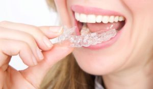 تقويم الأسنان البلاستيكي