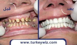 زراعة الاسنان بالصور فى تركيا