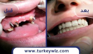 زراعة الاسنان بالصور فى تركيا