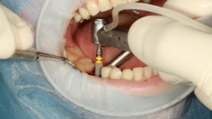 مخاطر زراعة الأسنان