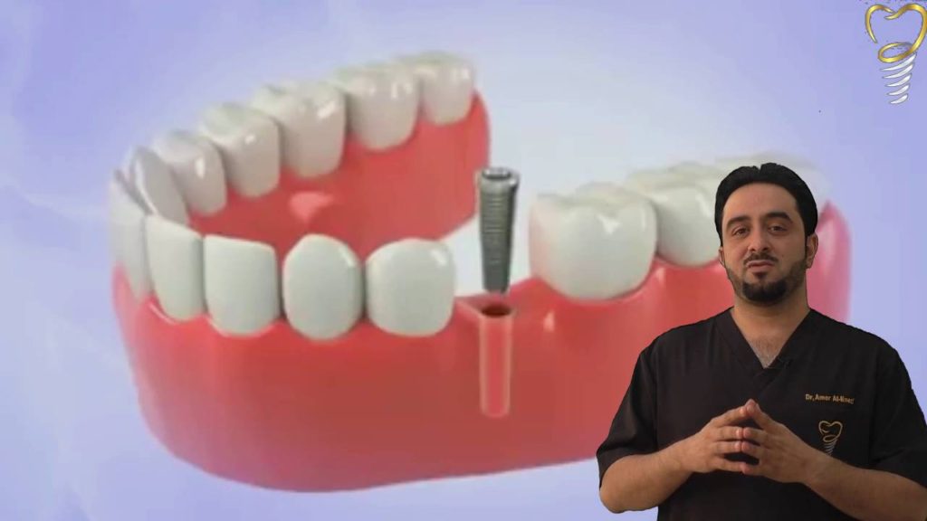 طرق زراعة الاسنان