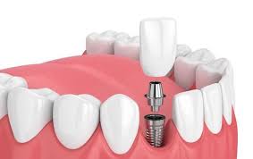 ما هي عملية زراعة الاسنان