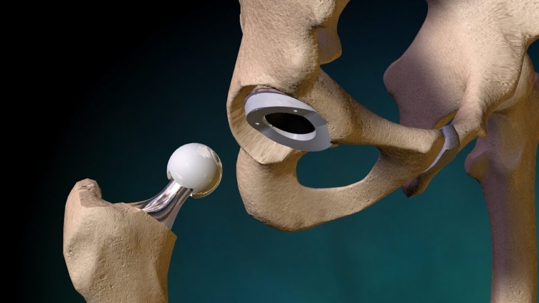 Восстанавливается тазобедренный. Эндопротез тазобедренного сустава Ильза. Эндопротез тазобедренный Титан керамика. Эндопротез тазобедренного сустава DEPUY. Implantcast тазобедренный сустав.