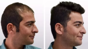 تجارب زراعة الشعر في تركيا