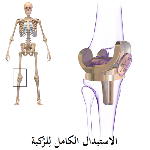 مدة عملية تغيير مفصل الركبة