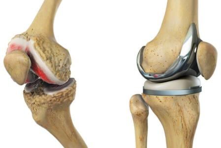 عملية استبدال مفصل الركبة في تركيا