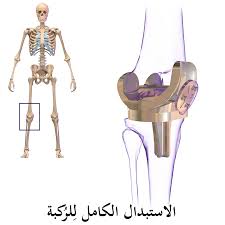 عملية تبديل مفصل الركبة في تركيا