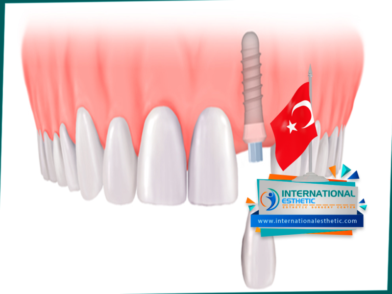 زراعة الأسنان الفورية في تركيا